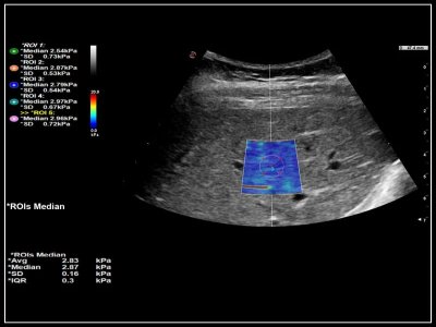 QElaXto 2D ShearWave elastografija jeter