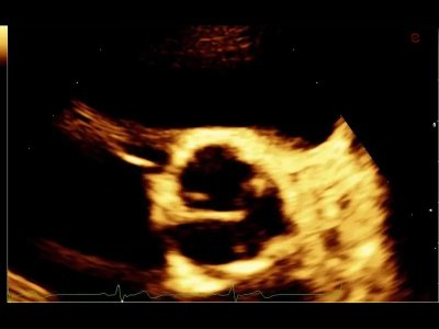 Aorta