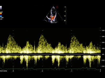 Polm Doppler