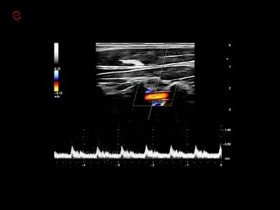 Vertebralno PW