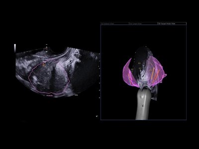 Urofusion Kartiranje vzorcev