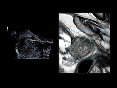 Urofusion TP biopsija
