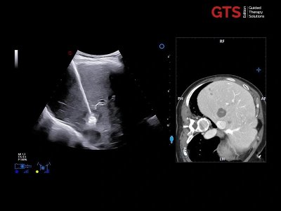 Fuzija jeter med CT in UZ v realnem času