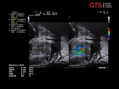 ShearWave elastografija prostate