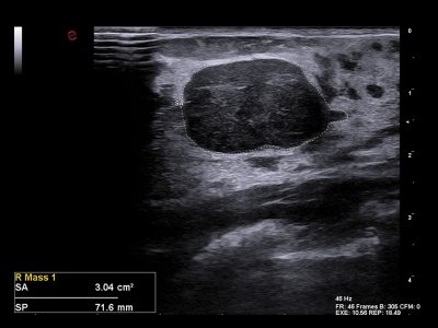 Tehnologija Breast Mass Analyzer-BMA