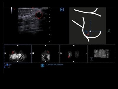 Tehnologija BreastNav MRI