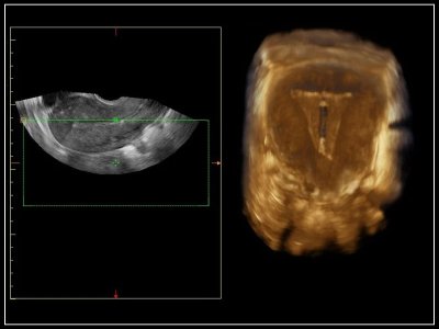 Prikaz IUD s 3D endokavitarno sondo