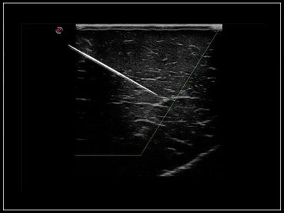 Prikaz konice igle z Needle Enhancement