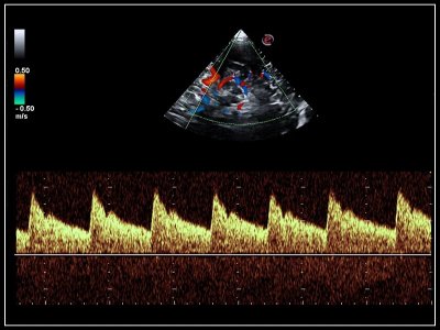 Transkranialni Doppler