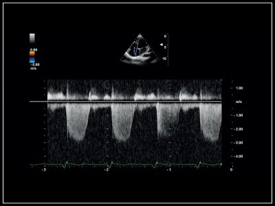 CW Doppler trikuspidalne regurgitacije