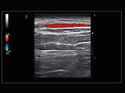 Temporalna arterija, sonda 22 MHz