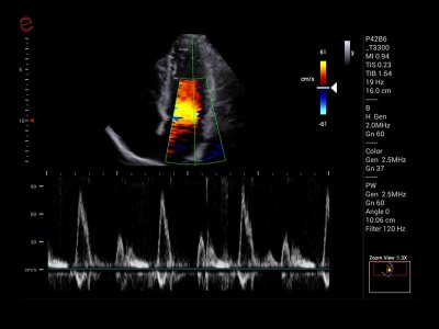 Kardiovaskularno Doppler